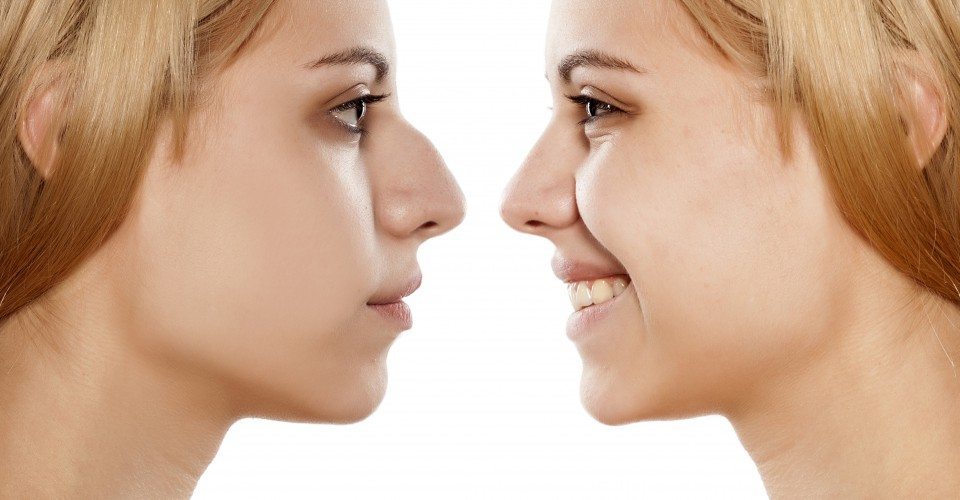 Rhinoplasty