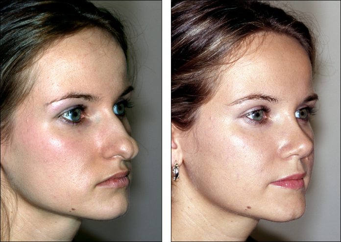 Rhinoplasty