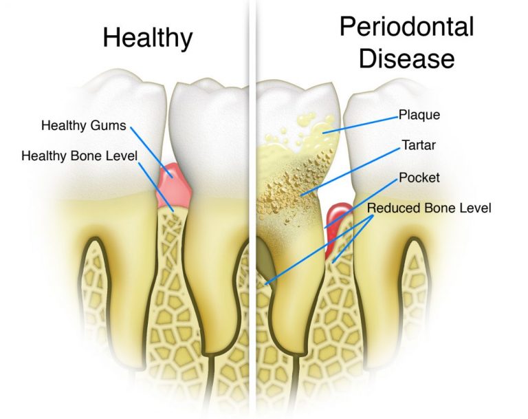 Periodontal disease – What Is It?