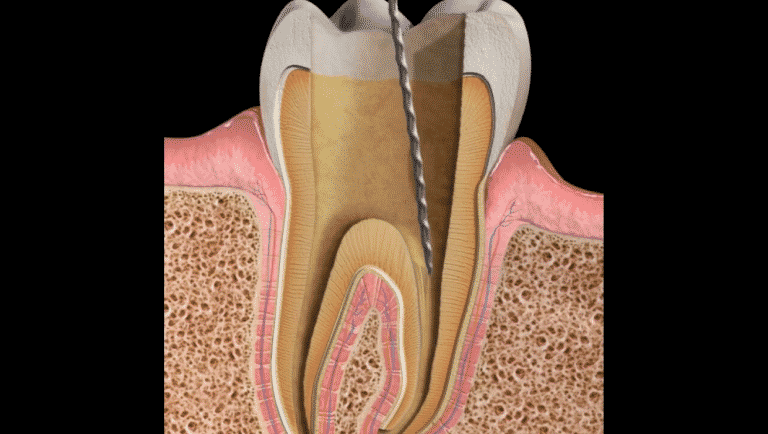 Apexification